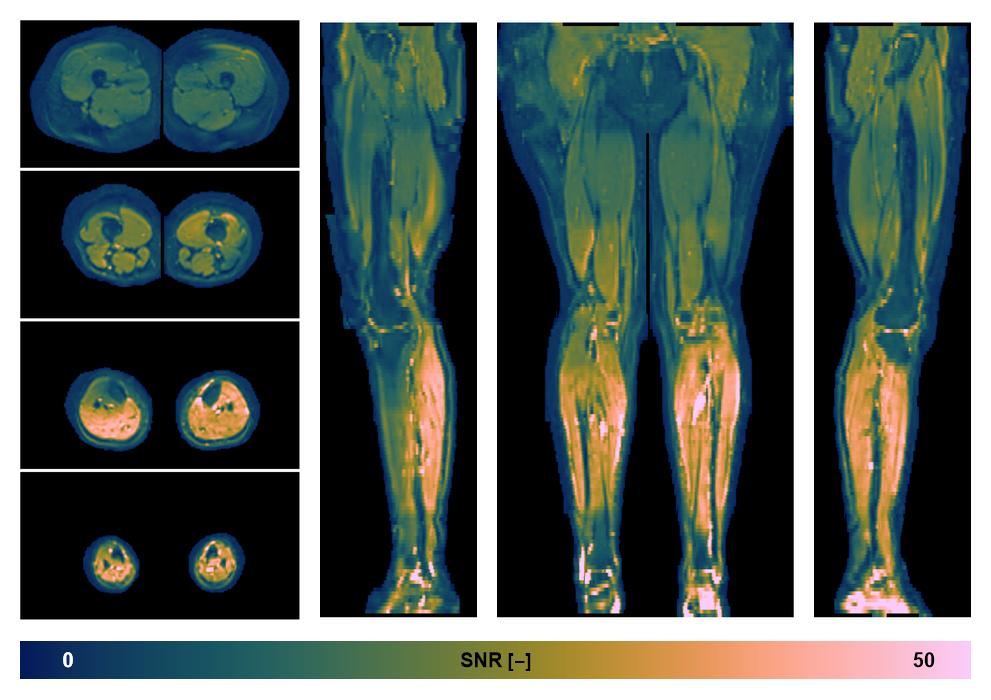 SNR distribution of the unweighted diffusion data.